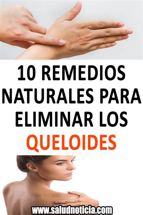 remedios para queloide